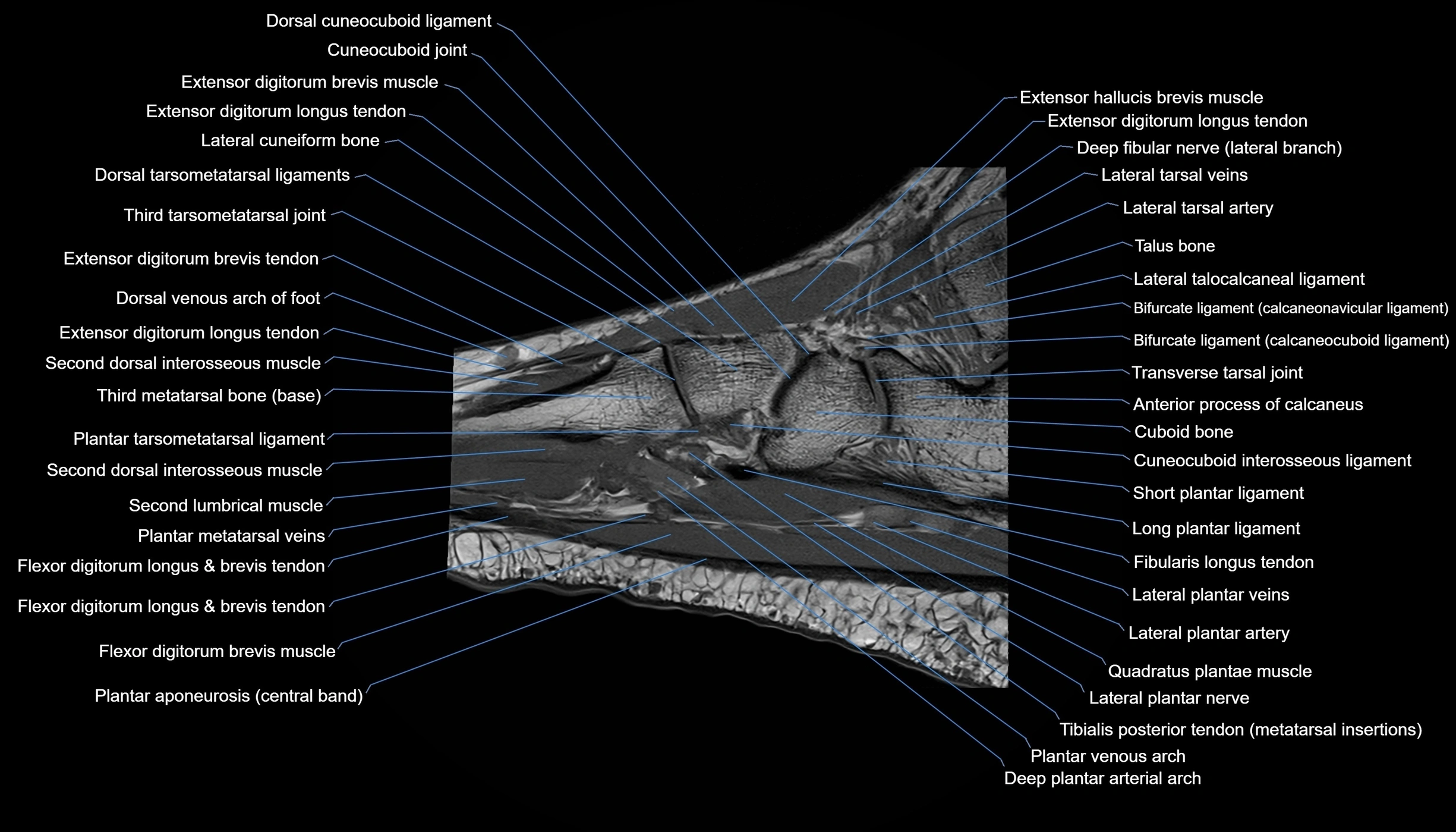 MRI mid foot sagittal cross sectional anatomy 3T  radiology  image-img-00001-00018.webp